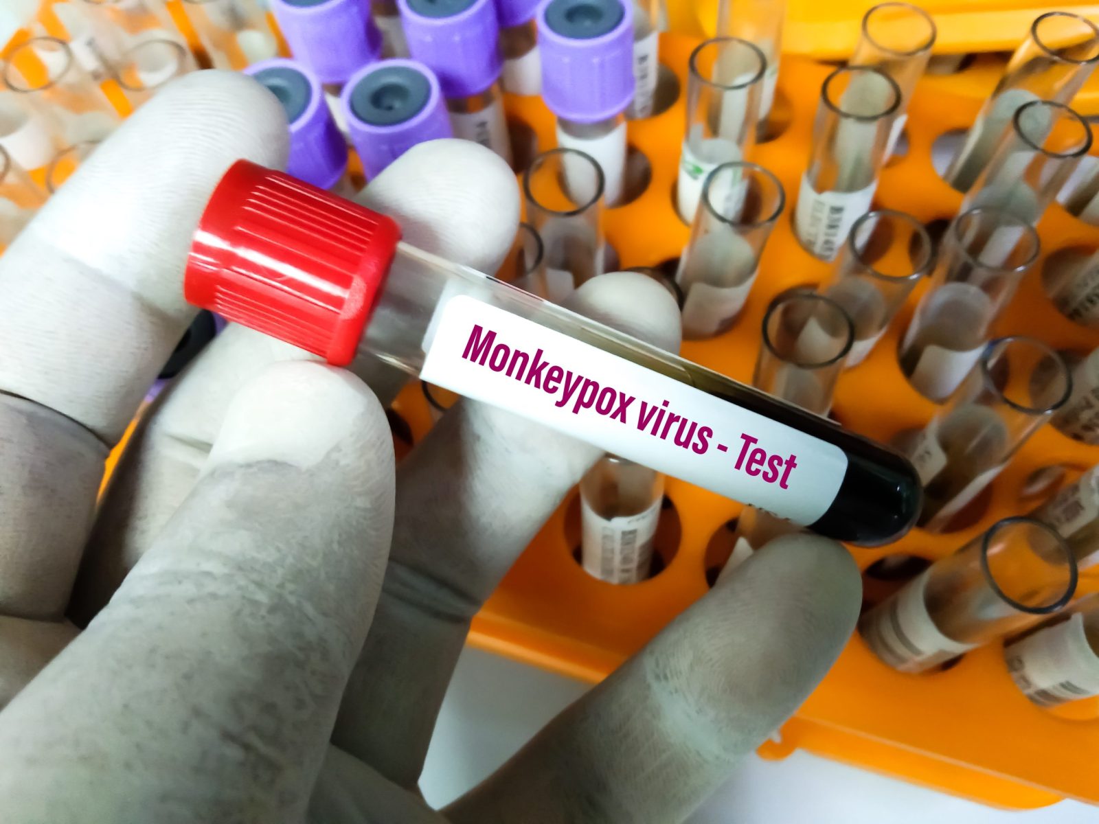 Monkeypox blood sample tube